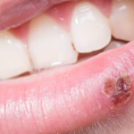 Why Do I Keep Getting Cold Sores Causes And Prevention