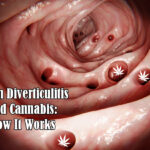 Colon Diverticulitis And Cannabis How It Works