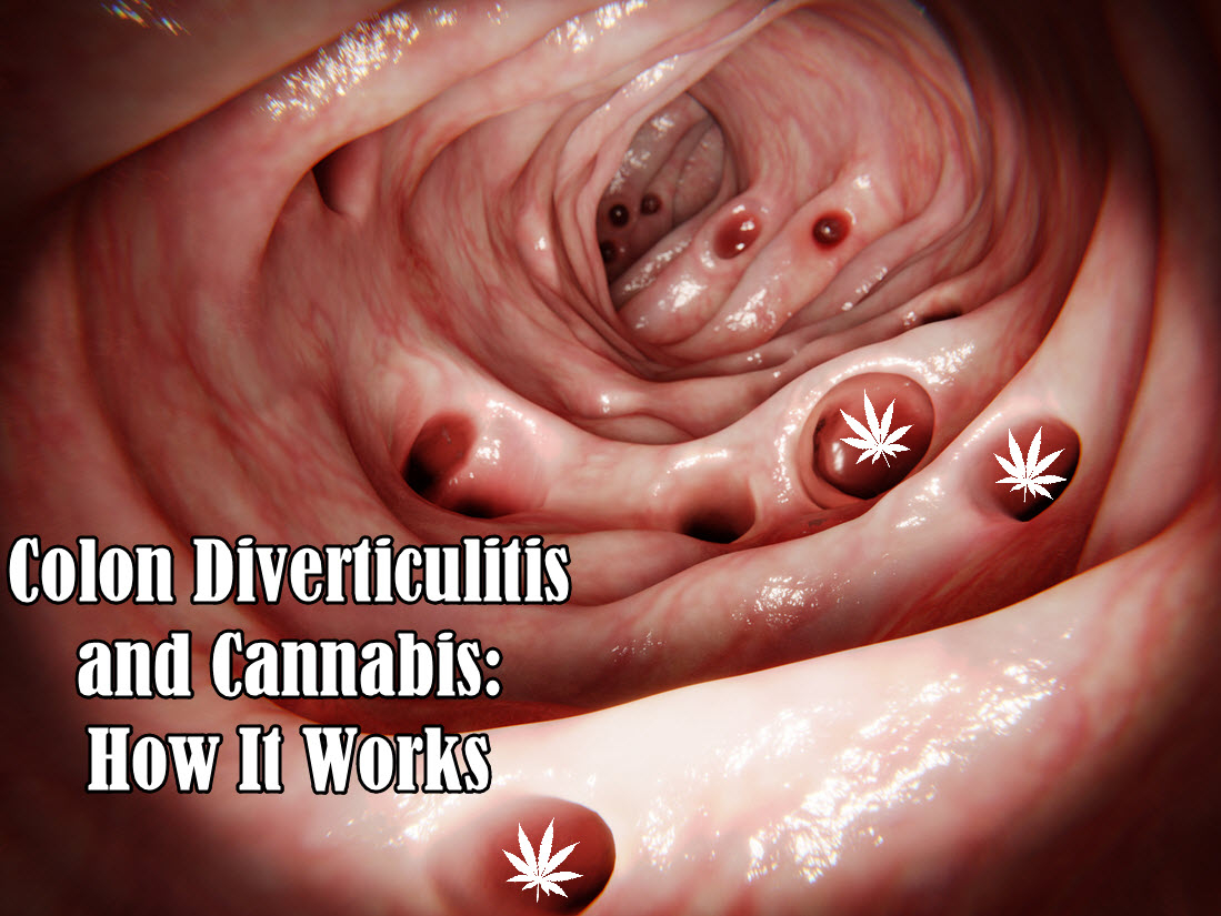 Colon Diverticulitis And Cannabis How It Works