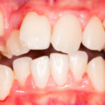 Do You Have Malocclusion Blog Coburg Dental Group Melbourne