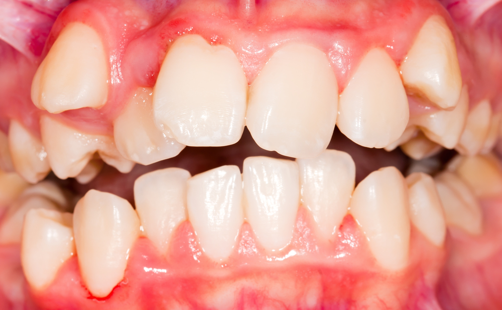 Do You Have Malocclusion Blog Coburg Dental Group Melbourne