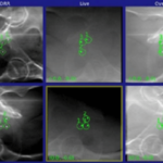 Enabling State Of The Art Radiotherapy Gold Anchor