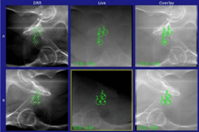 Enabling State Of The Art Radiotherapy Gold Anchor