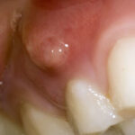 Gum Boils What They Are And How To Treat Them