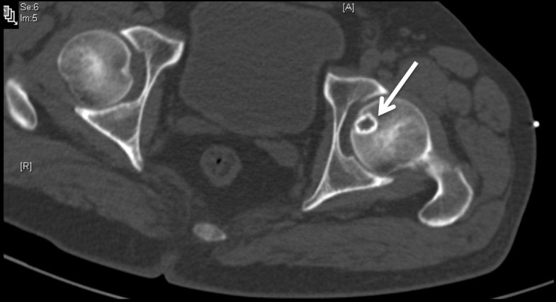 Osteoid Osteoma Of The Femoral Head Treated By Radiofrequency Ablation