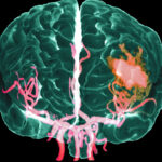 Physical Executive Function Most Affected After Ischemic Stroke