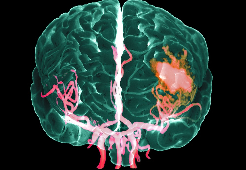 Physical Executive Function Most Affected After Ischemic Stroke