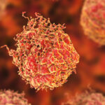 Tumor Cell Type Identified That Makes Prostate Cancer More Aggressive